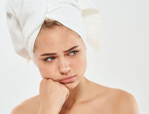 Truths and misconceptions about acne