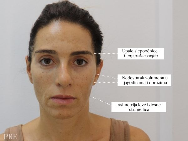asymmetry, loss of facial volume