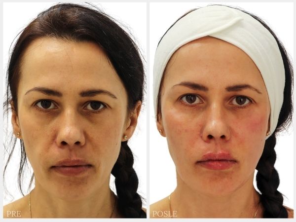 pre i posle remodelacija lica filerima