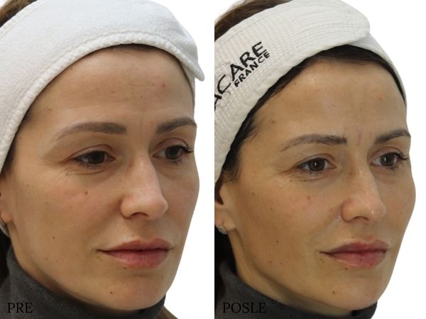 before and after hyaluronic fillers semi-profile
