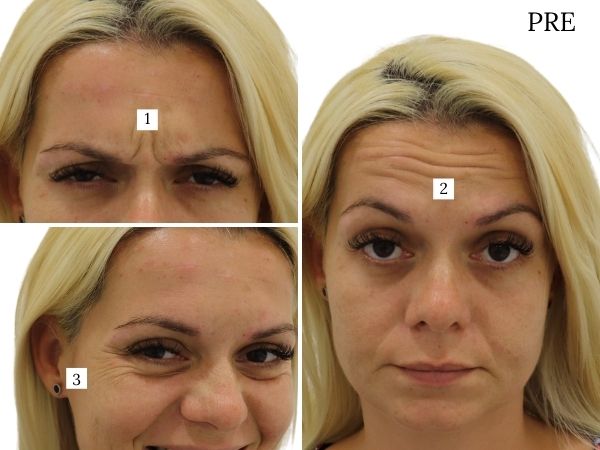 before correction hyaluronic fillers