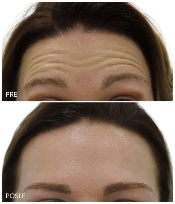 pre i posle korekcija bora na čelu oko očiju 1