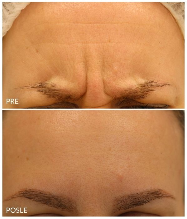 pre i posle korekcija bora na čelu oko očiju 6