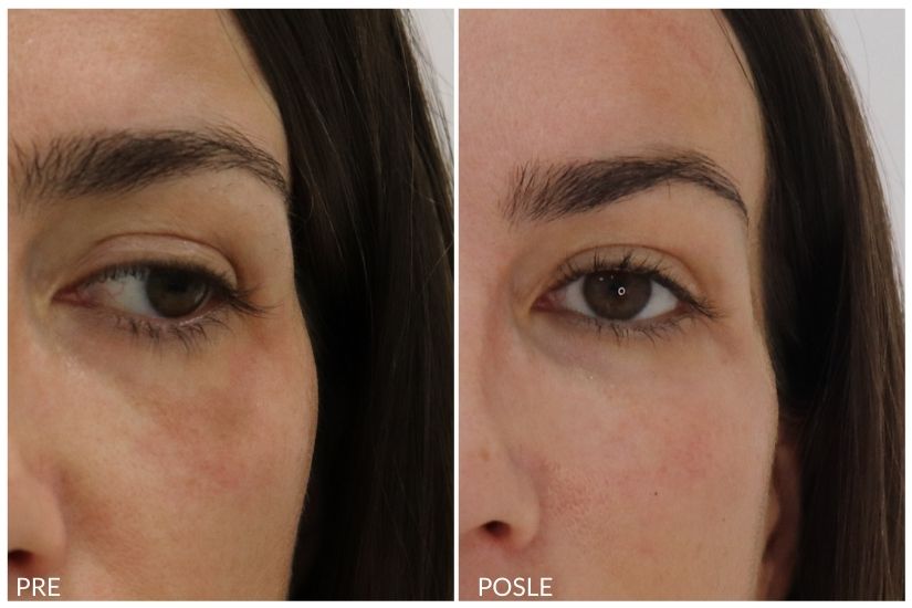 before and after dark circles hyaluronic fillers 12