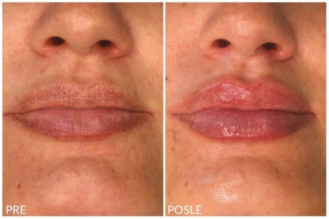 lips before and after hyaluronic 12