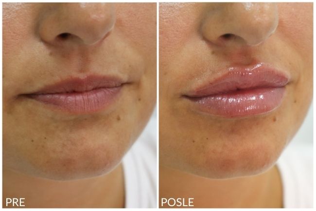 lips before and after hyaluronic 5