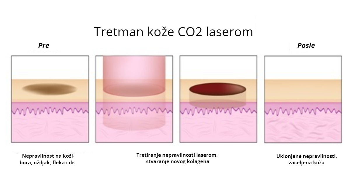 fractional laser skin collagen