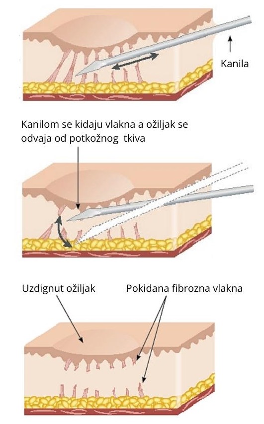 subcizija ožiljci akne