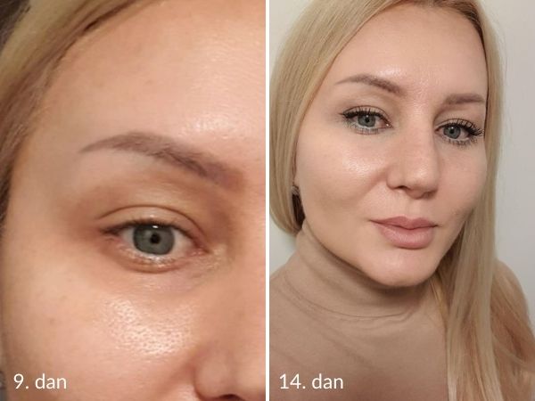 eyelid correction with laser recovery before and after