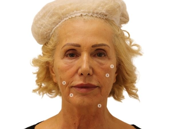 Skin and face rejuvenation after 50. years