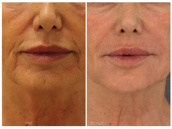 wrinkles around the lips co2 laser hyaluronan