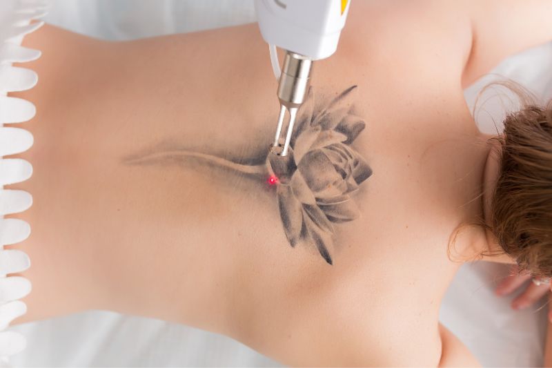 lasersko uklanjanje tetovaža