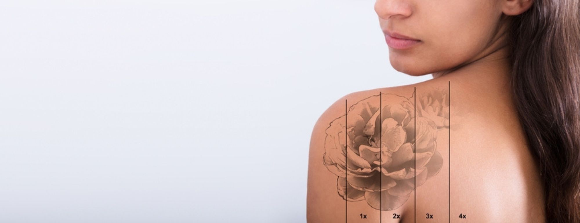 Lasers For Tattoos And Acne Scars | Fairview Laser Clinic Inc.