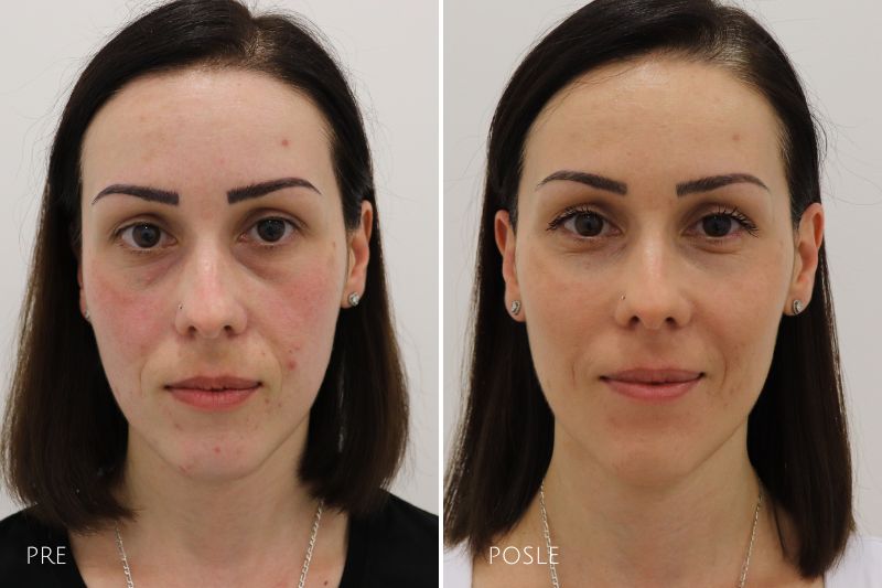 hyaluronic fillers before and after dark circles