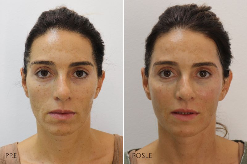 hyaluronic fillers lifting