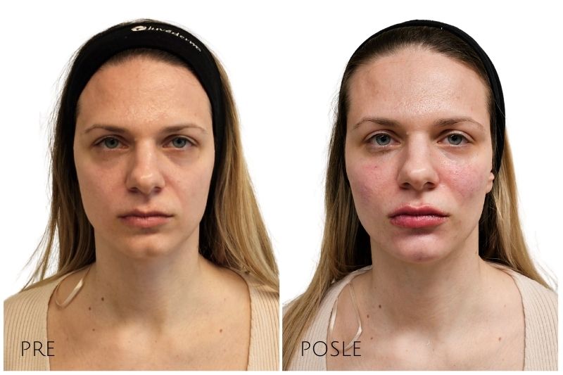 konturisanje lica filerima pre i posle